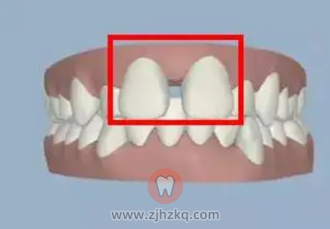 杭州树脂修复门牙牙缝价格
