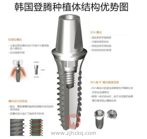 杭州口腔科普登腾种植体质量材质及优缺点