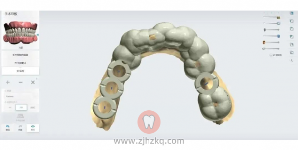 杭数口腔数字化舒适种植牙技术介绍