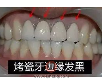 杭州口腔科普烤瓷冠全瓷冠价格对比区别