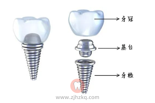 杭州口腔医院种牙贵吗好不好？