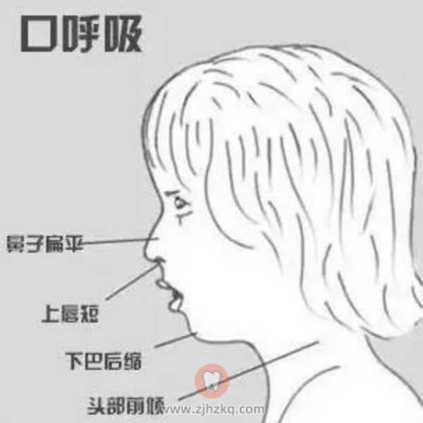 杭州口腔科普孩子口呼吸危害及治疗