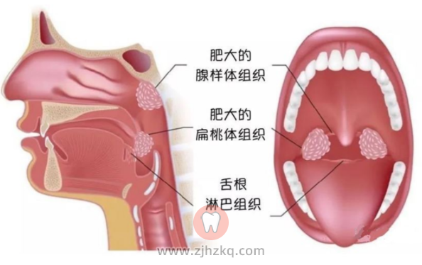 杭州口腔科普孩子口呼吸危害及治疗