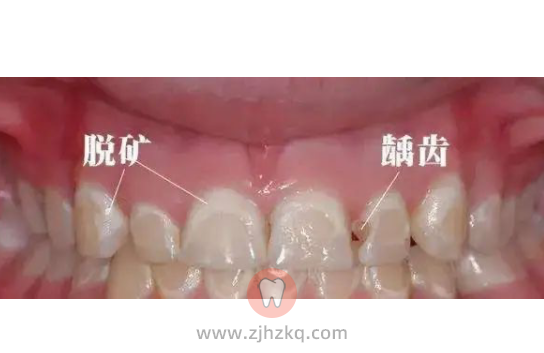 孩子牙齿脱矿附照片图片自查