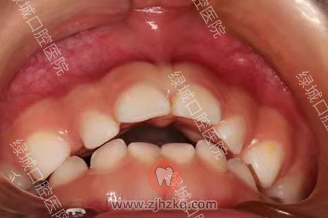 杭州绿城口腔医院早期矫治牙列不齐正畸案例