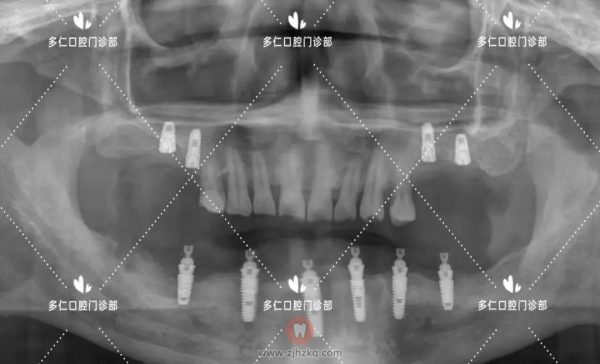 杭州多仁口腔半口及多颗牙无痛微创种植牙案例