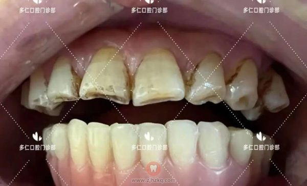 杭州多仁口腔半口及多颗牙无痛微创种植牙案例