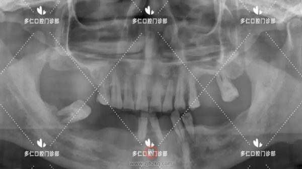杭州多仁口腔半口及多颗牙无痛微创种植牙案例