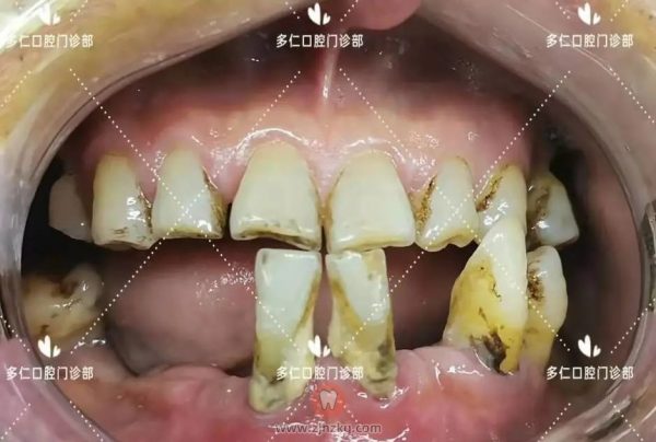 杭州多仁口腔半口及多颗牙无痛微创种植牙案例