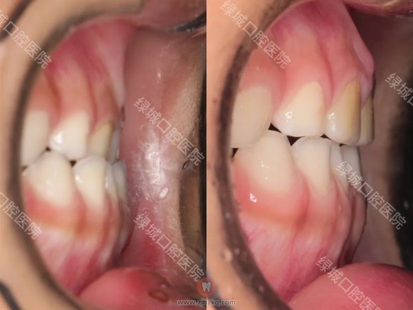 杭州绿城口腔医院早期矫治口呼吸地包天正畸案例