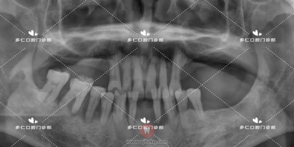 杭州门牙即拔即种即刻修复种植牙案例分享