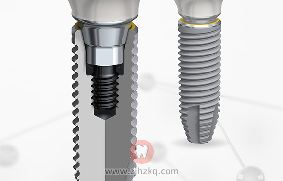 如何选择一个靠谱的可以用一辈子的种植体