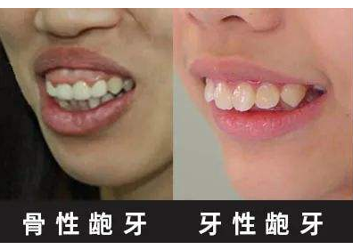骨性龅牙牙性龅牙区别附图片