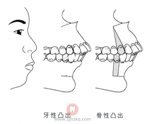 骨性龅牙牙性龅牙区别附图片
