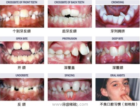 儿童早期矫治是不是过度医疗和骗局