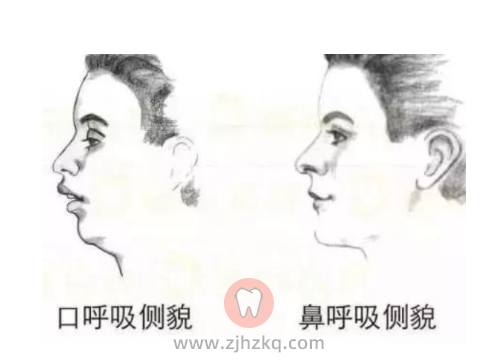 儿童早期矫治是不是过度医疗和骗局