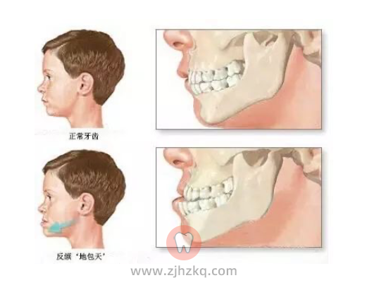 儿童早期矫治是不是过度医疗和骗局