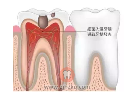 牙齿剧烈疼痛代表牙髓炎症