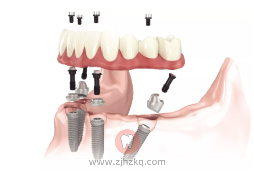 杭州某口腔医院去种牙让我先治牙周炎是套路和过度医疗吗