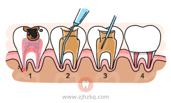 补牙怎么把牙洞越磨越大了原来我误解牙医了