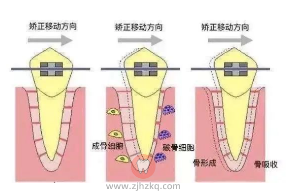 超过30岁牙齿还能正畸矫正吗？
