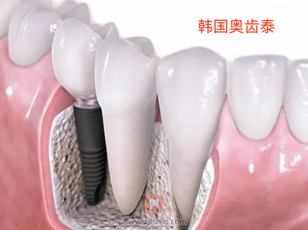 杭州种牙韩国奥齿泰和登腾种植牙哪个好？