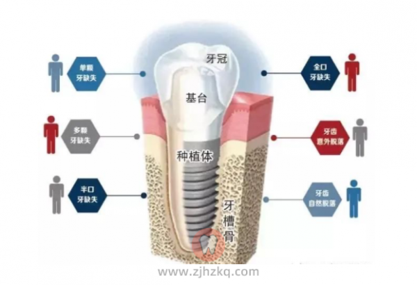 烤瓷牙搭桥牙和种植牙区别