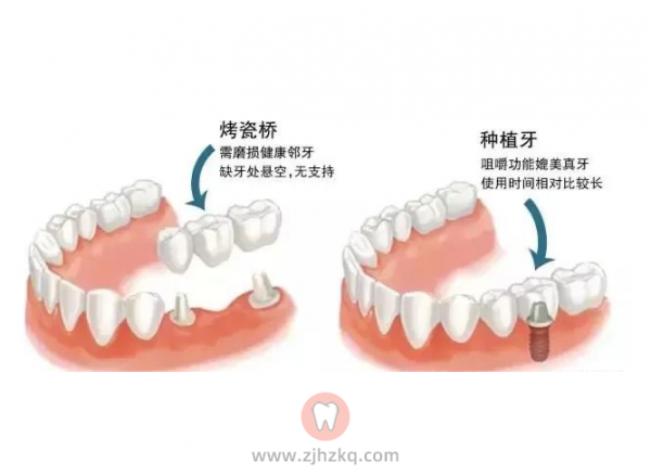 烤瓷牙搭桥牙和种植牙区别