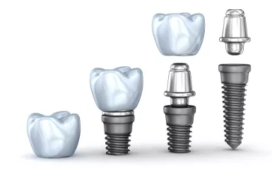 杭州种植牙镶牙哪个更实惠性价比更高