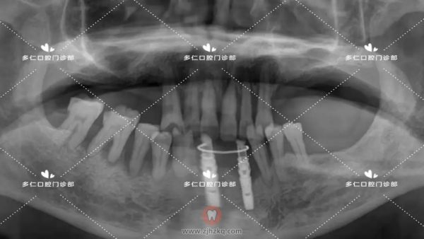 杭州门牙即拔即种即刻修复种植牙案例分享