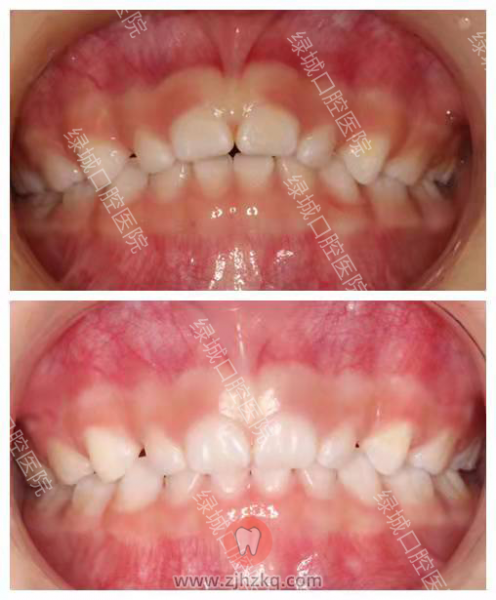 杭州绿城口腔医院早期矫治牙列不齐正畸案例