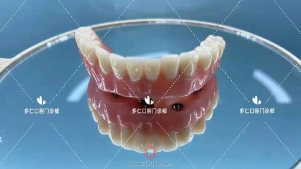 杭州多仁口腔半口及多颗牙无痛微创种植牙案例