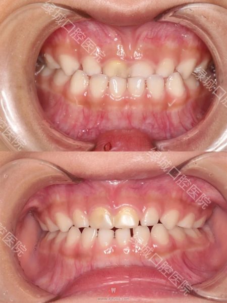 杭州绿城口腔医院早期矫治口呼吸地包天正畸案例