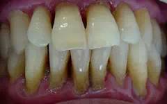 中期牙周炎照片