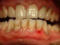 早期牙周炎照片