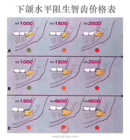 杭州拔智齿收费差别太大了