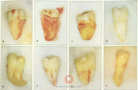 拔智齿能一次性拔4颗吗？