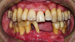 晚期牙周炎照片