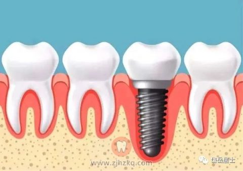 种植牙医生谈谈种植牙集采