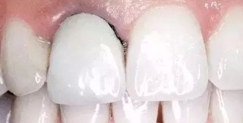 烤瓷牙让牙龈发黑图片