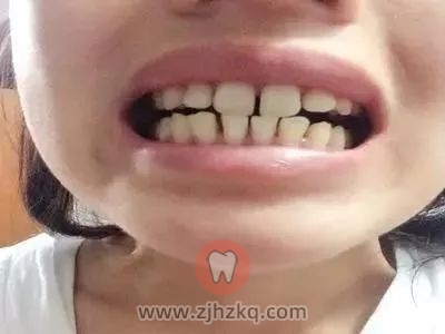 杭州儿童门牙间隙大去什么医院？