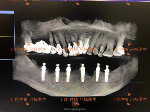 杭州杭承口腔下颌半口种植牙种牙记