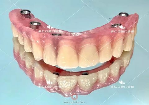 杭州多仁口腔半口即拔即种即刻修复案例