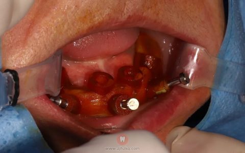 **口腔科张建兴72岁老人种牙记