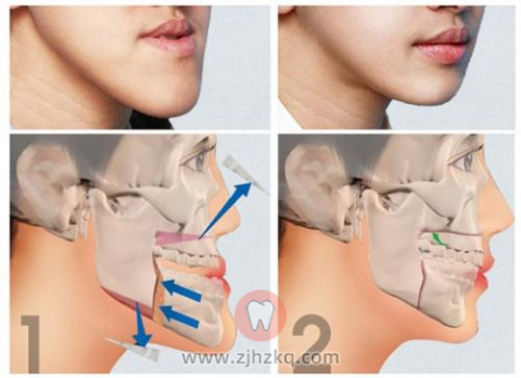 地包天（反颌）照片图片