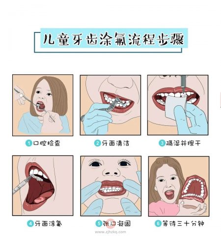 杭州儿童牙齿涂氟流程