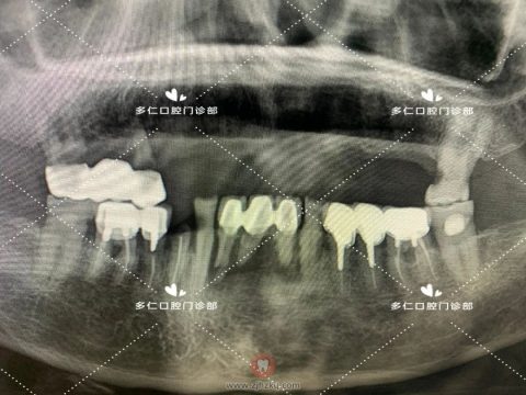 杭州多仁口腔半口即拔即种即刻修复案例