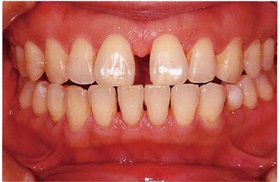 慢性牙周炎轻度口腔内照片