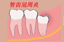智齿疼痛难忍是什么原因造成的