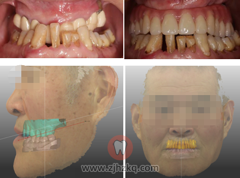 浙江省**口腔科牙科主任杨帆种牙记